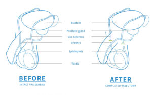 How soon after a vasectomy can you have sex - Direct Access Vasectomy
