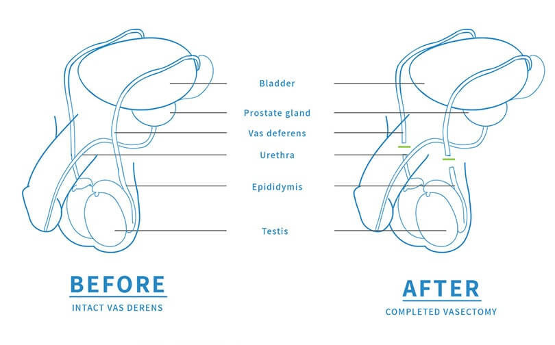 No-Scalpel Approach vasectomy