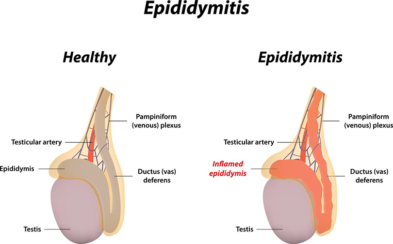 Epididymitis 01